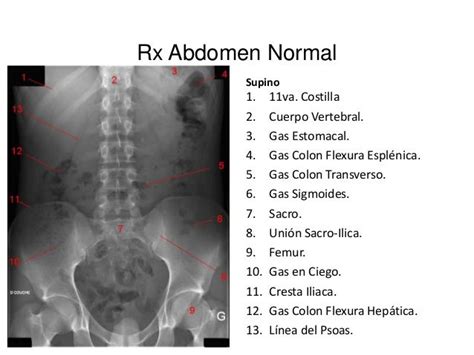 Guía Paso A Paso Para Interpretar Una Radiografía De Abdomen Artofit