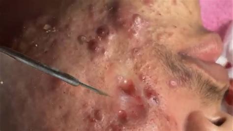 Large cystic acne, big cystic acne, and small cystic acne can be reduced by having fresh fruits and vegetables. WOW huge cystic acne extraction and blackhead removal ...
