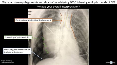 Tension Pneumothorax Cxr Teachim