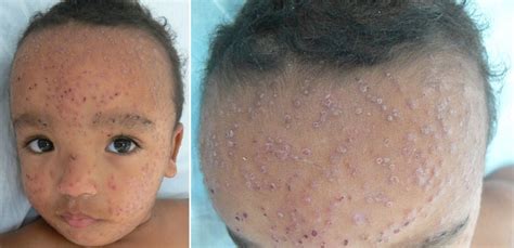 Papular Crusted Rash In A Child After Immunisation Archives Of