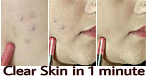 Remove Pimples In 1 Minute Clear Skin Live 100 Results Youtube