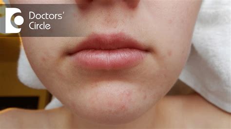 Acne Around Mouth Causes Prevention And Treatment Images