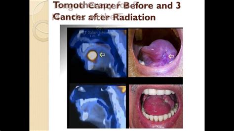 Radiation For Head And Neck Cancer Youtube