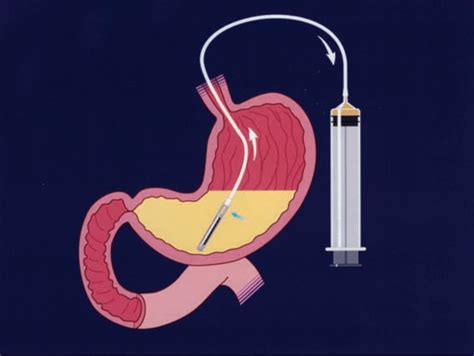Monitoring For Intolerance To Gastric Tube Feedings Off The Charts