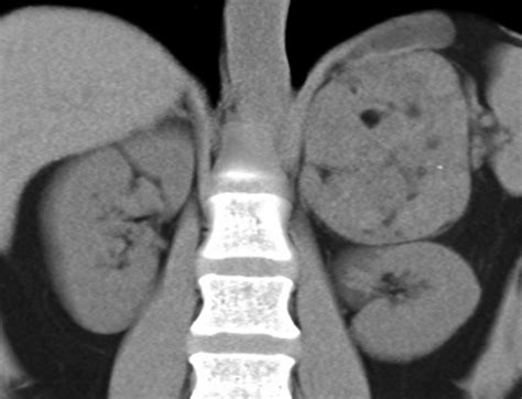 Adrenal Mass Imaging With Multidetector Ct Pathologic Conditions