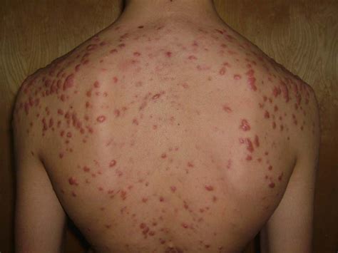 body acne | Medical Pictures Info - Health Definitions Photos
