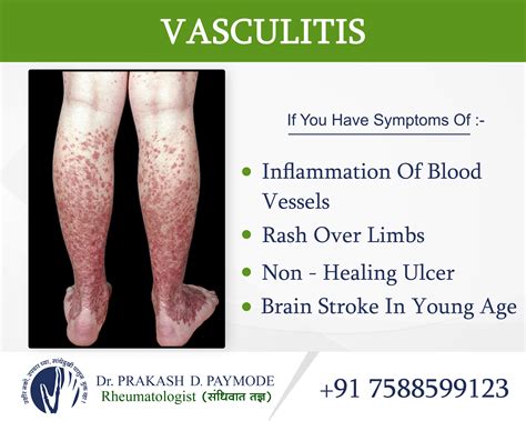 Vasculitis Dr PrakashPaymode