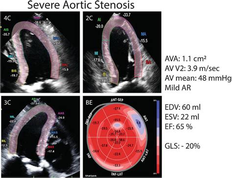Clinical Applications Of Strain Imaging In Aortic Valve Disease