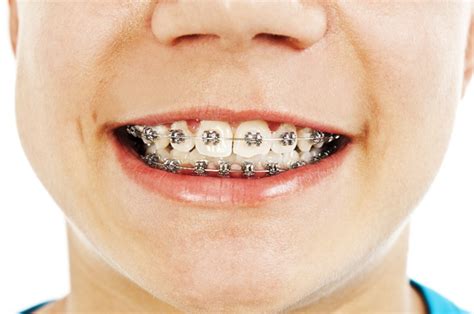 What You Need To Know About Caring For Your Childs Braces