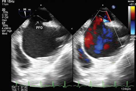 Isolated Right Ventricle Mass The Role Of Echocardiography In