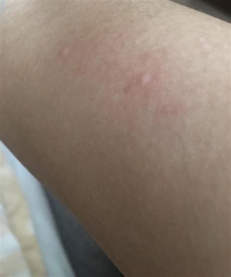 Superdrug Health Clinic Little Itchy Bumps On Legs