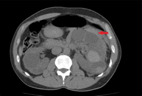Retroperitoneal Hemorrhage How To Detect Describe And How To Make Hot