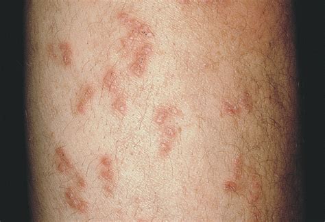 A Long Standing Keratotic Papular Eruption Dermatology Jama