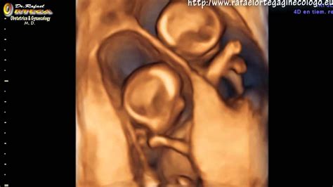 4d Ultrasound 12 Weeks Pregnant Twins Jumping Rafael Ortega Muñoz Md Ci