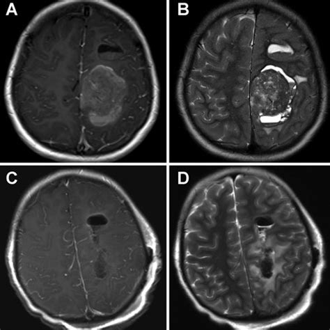Axial Postcontrast T1 Weighted A And T2 Weighted B Mr Images