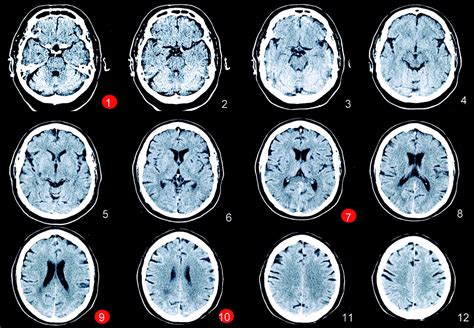 Hyperacute Stroke Experience Essential When Reading Unenhanced Ct