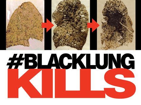 How To Apply For Black Lung Benefits