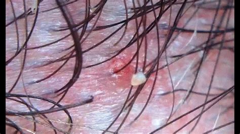 Popping Inflamed Hair Follicle On Scalp Youtube