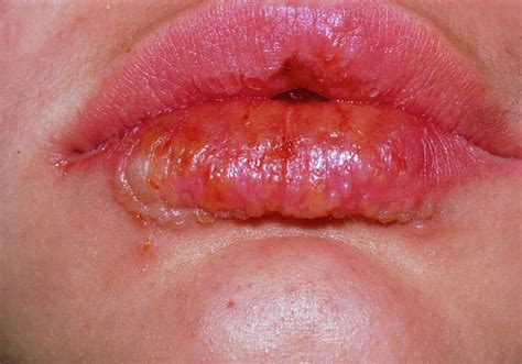 Lips Infected By The Herpes Simplex Virus Photograph By Science Photo