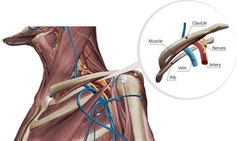 Thoracic Outlet Syndrome Treatment In Nyc Nydnrehab