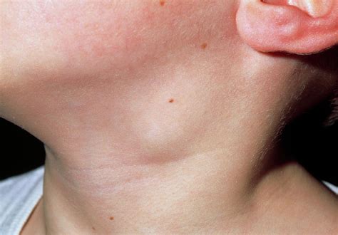 Close Up Of Swollen Lymph Node In The Neck Of Babe Photograph By Dr P