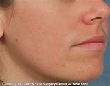Images of Laser Treatment To Remove Scars On Face