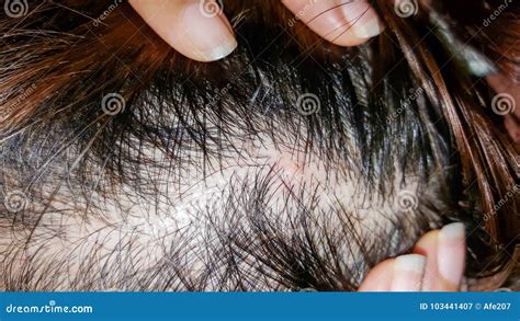 Abscess On Skin Head Stock Image Image Of Doctor Blood 103441407