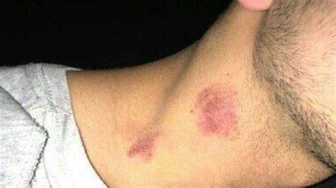 how to get rid of a hickey in seconds with toothpaste - YouTube