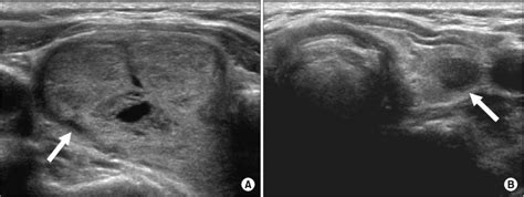 Ultrasonographic Features Of The Bilateral Thyroid Nodules Axial View