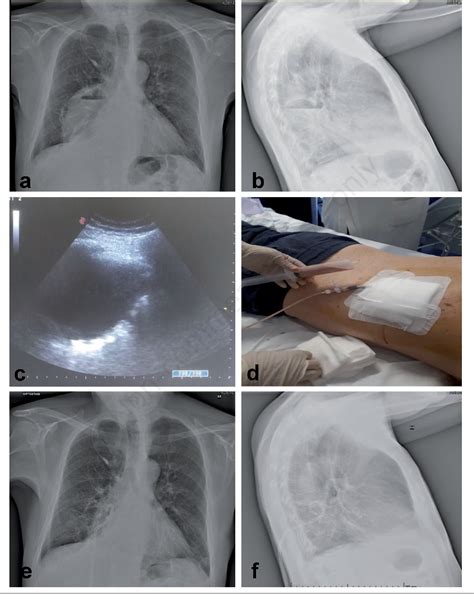 Percutaneous Drainage Of Pyogenic Lung Abscess Best Drain Photos My