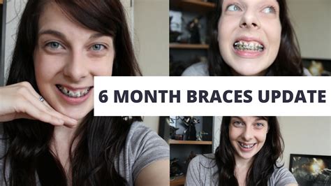 6 Month Adult Braces Update Youtube