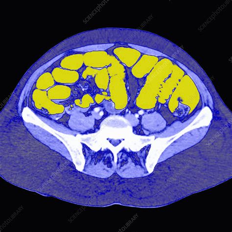 Normal Intestines Ct Scan Stock Image C0269037 Science Photo