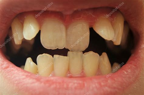 Close Up Of Crooked Teeth — Stock Photo © Vlue 4626014