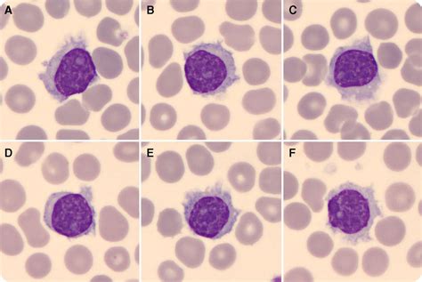 Medical Laboratory And Biomedical Science A Variant Of Hairy Cell Leukemia