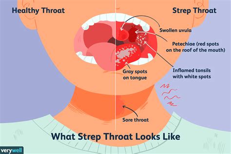 Strep Throat Causes Symptoms And Treatment Nursa
