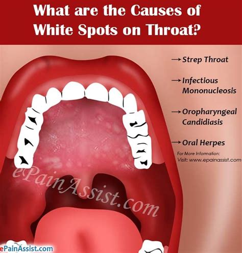 What Are The Causes Of White Spots On Throat Throat Infection Strep