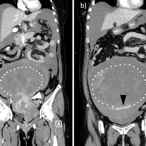 Figure1first Abdominal Contrast Enhanced Computed Tomography Images