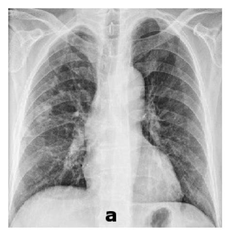 Pretreatment Chest X Ray Revealed A Pulmonary Nodule A And Ct Scan