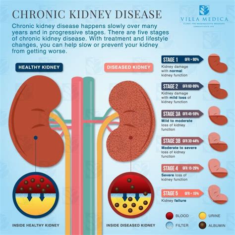 I Have Chronic Kidney Disease Stage 3