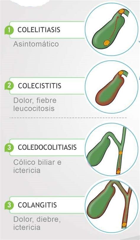 Vesícula biliar colelitiasis colecistitis coledocolitiasis colangitis