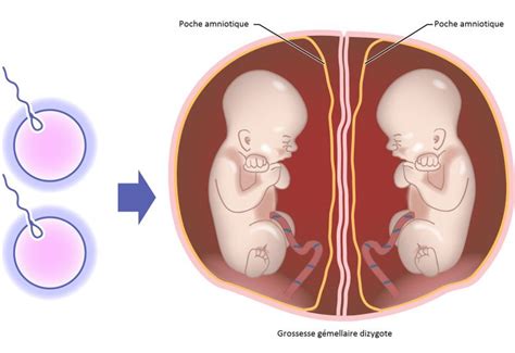 Grossesse gémellaire dizygote Neufmois fr