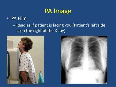 Ppt Basics Of Chest X Ray Powerpoint Presentation Free Download Id