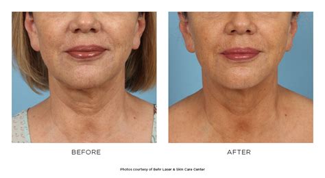 Ultherapy® Skin Tightening Fresno Ca Behr Laser And Skin Care Center
