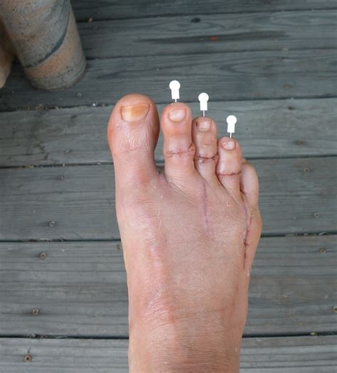 Pinned Foot Wellness Ally