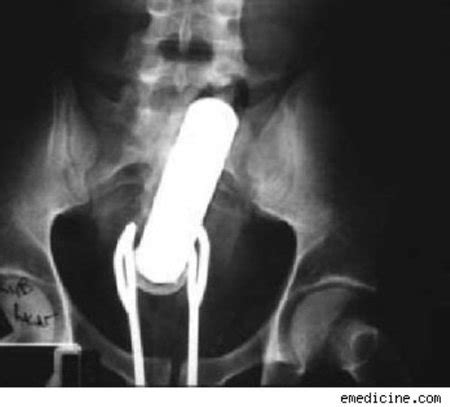 10 Craziest Foreign Objects Found Stuck In A Rectum Found Objects Oddee