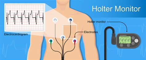 Holter Heart Monitor Ulsdace