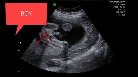 12 Weeks Pregnant Ultrasound Girl
