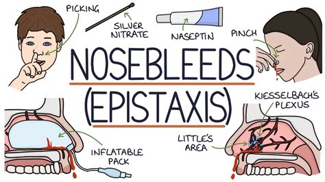 Understanding Nosebleeds Epistaxis Youtube