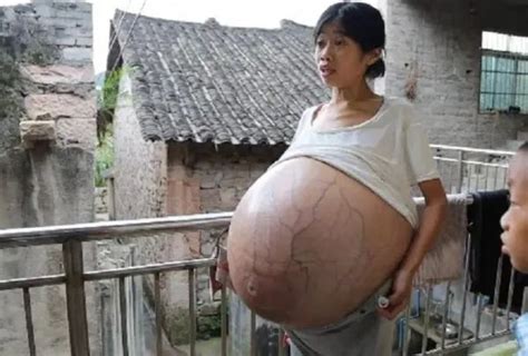 我“怀孕”了，“胎儿”40多斤，被忽视的妇癌之王，刺痛着14万女性 中国医疗