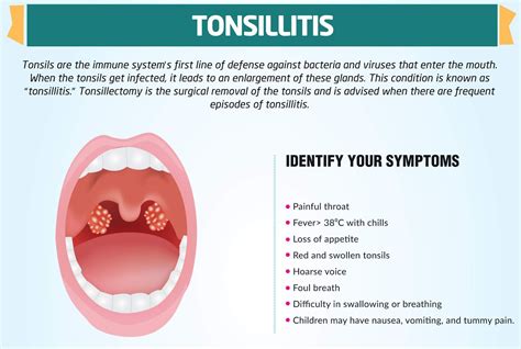 What Causes Swollen Tonsils With White Spots Adenoid Removal Tonsil
